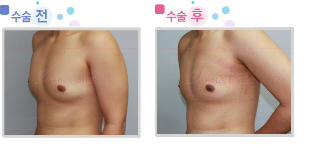 여유증 수술전후사진5 여유증 수술전후사진5
