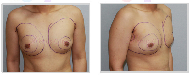 여유증 수술 디자인 여유증 수술 디자인