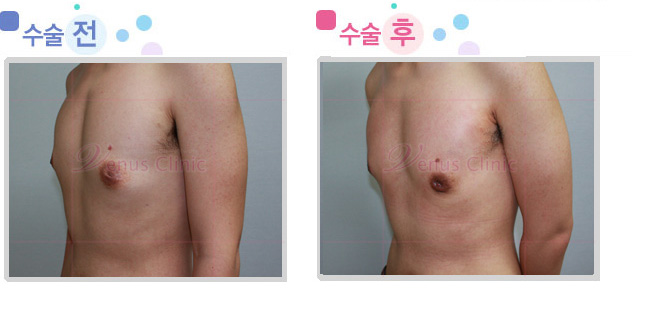 여유증 수술전후사진3 여유증 수술전후사진3