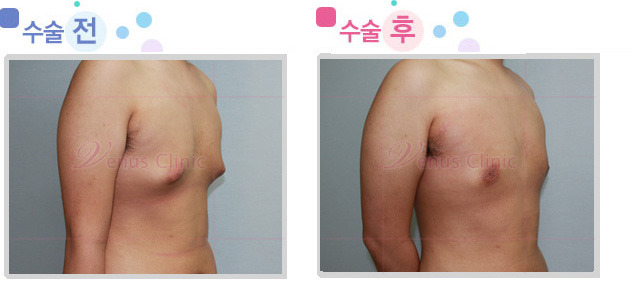 여유증 수술전후사진4 여유증 수술전후사진4