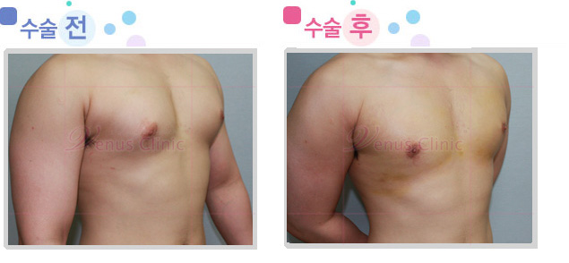 여유증 수술전후사진1 여유증 수술전후사진1