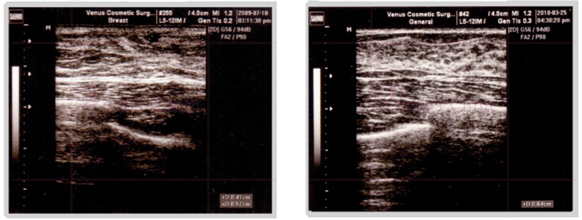 여유증 초음파 사진